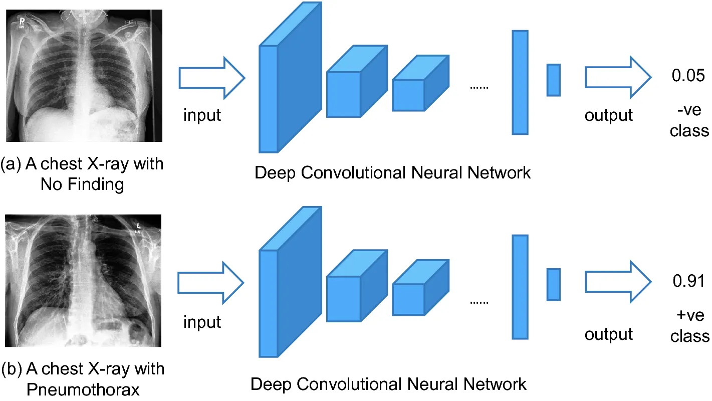 Using Convolutional Neural Networks in Tensorflow to Analyse Chest XRays