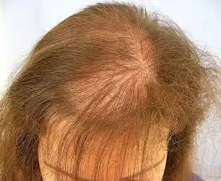 Medical and Other Conditions of Hair Fall & Hair Loss in UAE ?